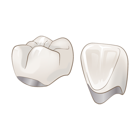 メタルセラミッククラウン