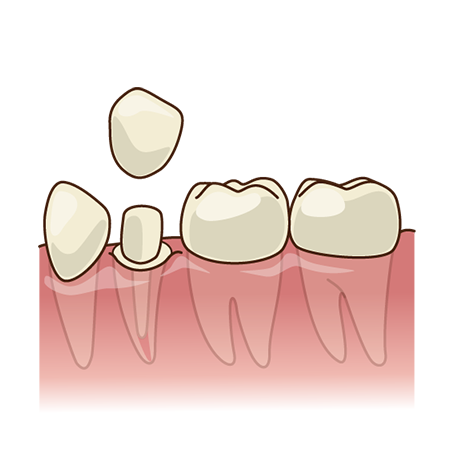 ファイバーコア